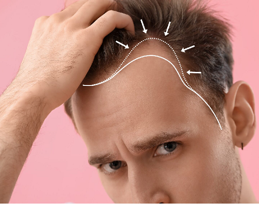 sapphire-fue-hair-transplant-turkey