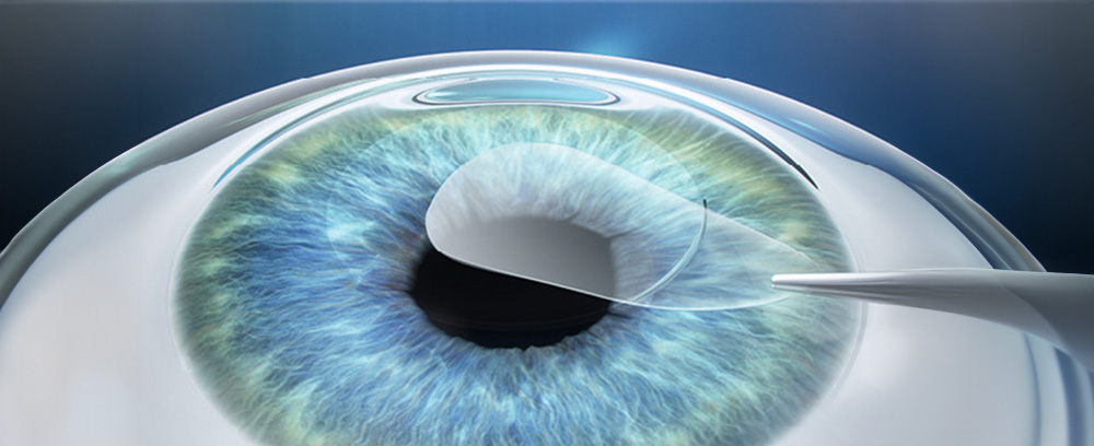 ReLEx SMILE Behandlungsbild