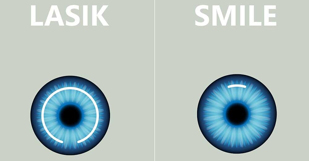 ReLEx SMILE Maschinenbild