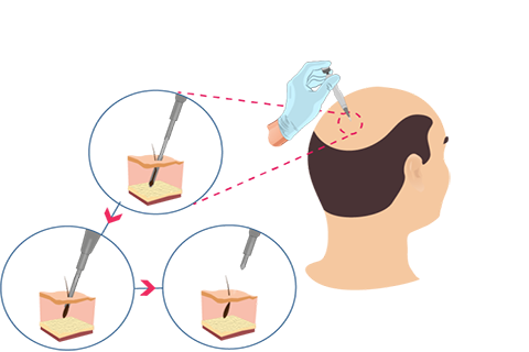 DHI-Haartransplantation