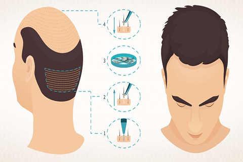 FUE-Haartransplantation