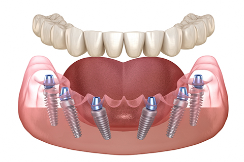 All on 6 Implantatbehandlung