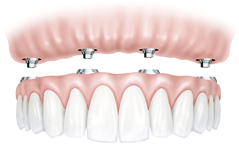 All on 4 Implantatbehandlung