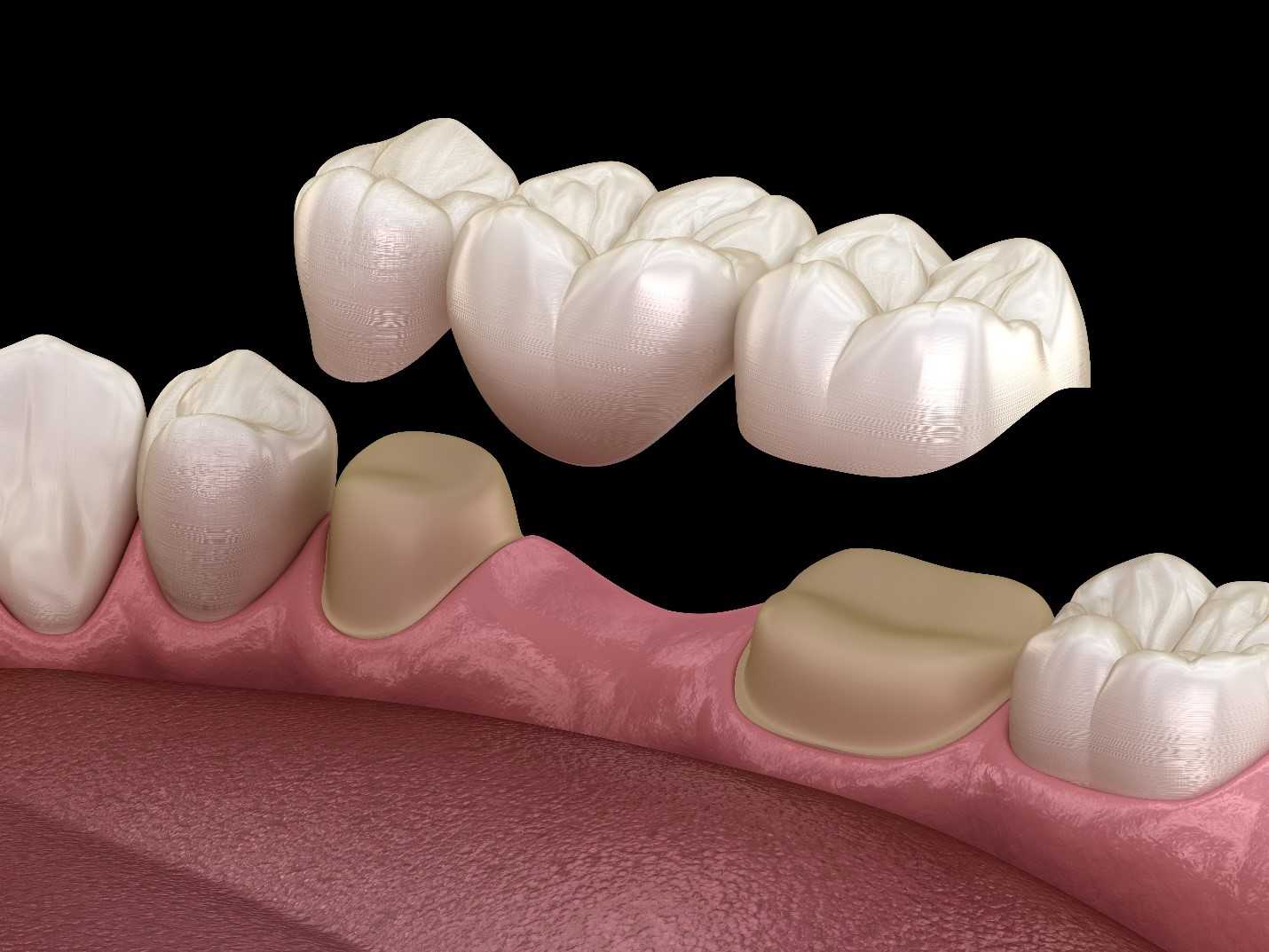 dental bridge 1