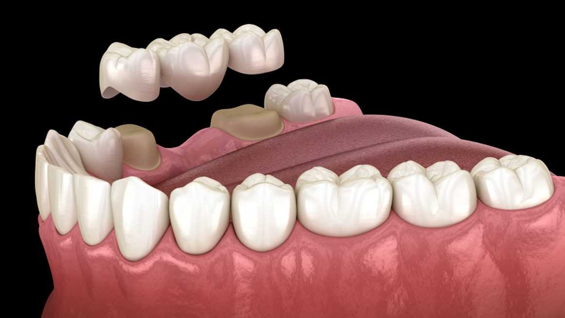 dentalbridge2