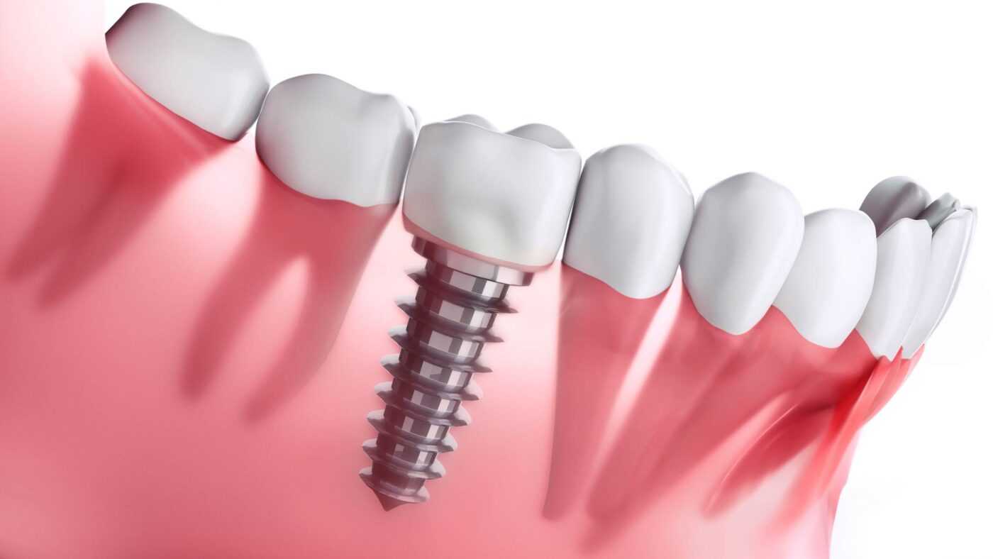 dentalimplant2