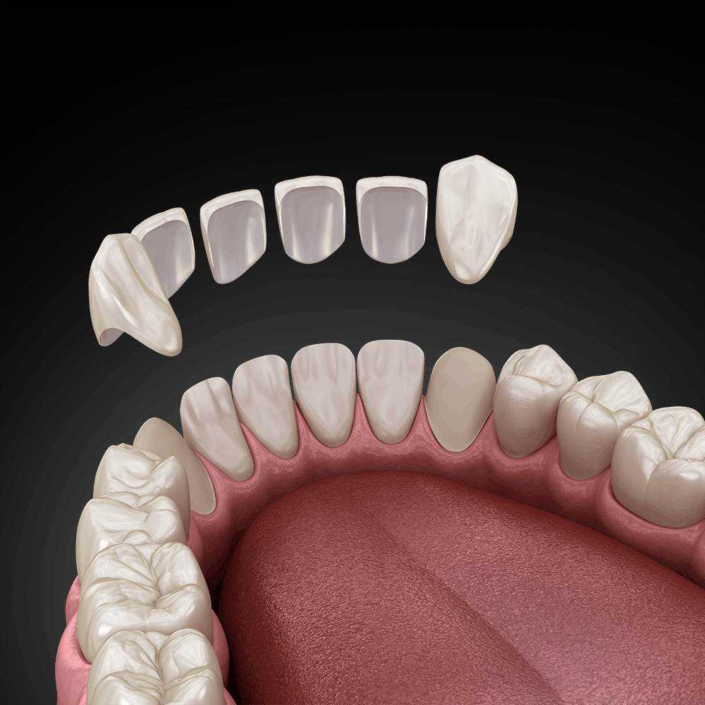 veneers1