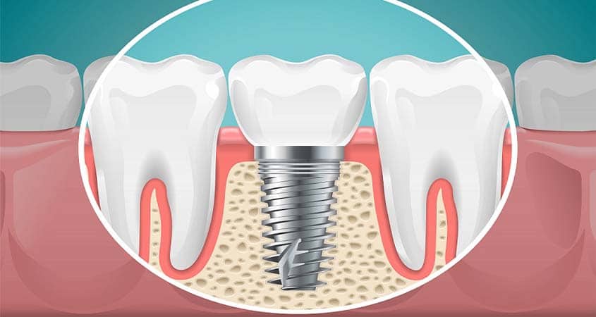 implant 1