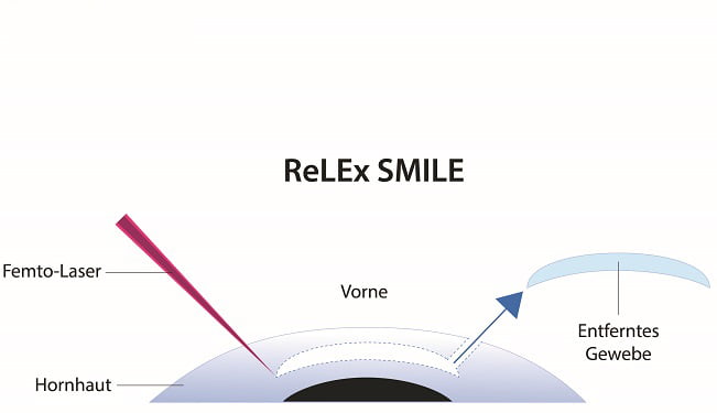 relex smile mapa