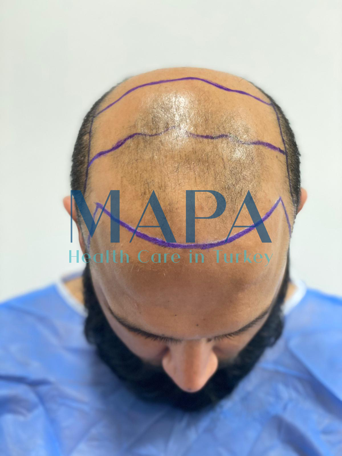 Resultaat van de behandeling